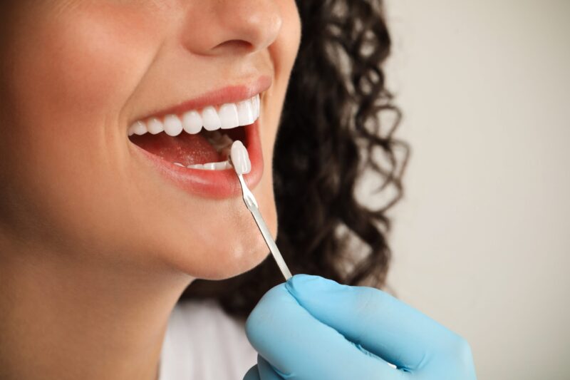 Dental Veneers Okemos