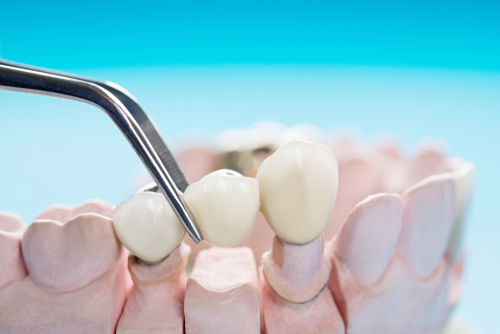 Dental Crowns Okemos
